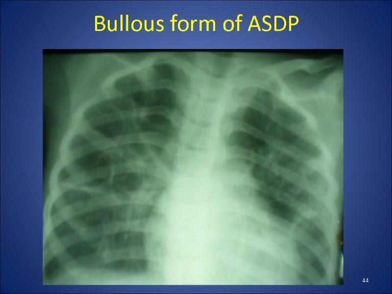 Bullous form of ASDP 44